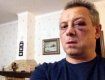 Владимир Куренной показал, как отморозки "отрихтовали" его лицо