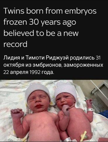 Непростые двойняшки появились на свет в США, их зачали еще 1992 году 