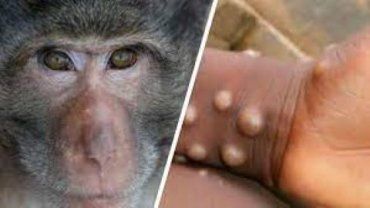 Оспа обезьян: Бразилия и Испания сообщают о первых случаях смерти